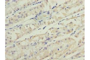 Immunohistochemistry of paraffin-embedded human gastric cancer using ABIN7173199 at dilution of 1:100 (TMEM31 Antikörper  (AA 1-118))