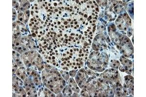 Immunohistochemical staining of paraffin-embedded Adenocarcinoma of colon tissue using anti-RC211175 mouse monoclonal antibody. (TUBA8 Antikörper)