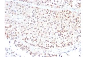 Formalin-fixed, paraffin-embedded human Bladder Carcinoma stained with p21 Mouse Monoclonal Antibody (DCS-60.