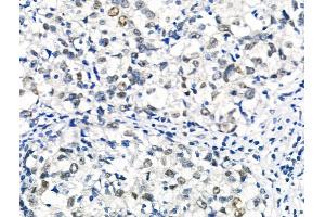 Phospho-RAD18 (Ser99) Antibody at 1/100 staining Human breast cancer by IHC-P. (RAD18 Antikörper  (pSer99))