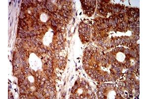 Immunohistochemical analysis of paraffin-embedded rectum cancer tissues using EIF5 mouse mAb with DAB staining. (EIF5 Antikörper  (AA 1-300))