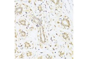Immunohistochemistry of paraffin-embedded human mammary cancer using STAT1 antibody. (STAT1 Antikörper  (AA 650-750))