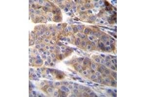 Immunohistochemistry analysis in formalin fixed and paraffin embedded human melanoma reacted with PLA2G2C Antibody (C-term) followed which was peroxidase conjugated to the secondary antibody and followed by DAB staining. (PLA2G2C Antikörper  (C-Term))