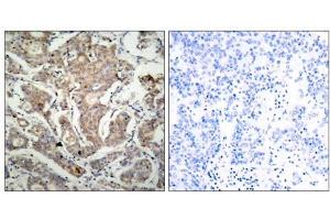 Immunohistochemical analysis of paraffin-embedded human breast carcinoma tissue using BAD (Ab-155) antibody (E021064). (BAD Antikörper)