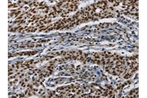 The image on the left is immunohistochemistry of paraffin-embedded Human gastic cancer tissue using ABIN7190953(HIST1H2AB Antibody) at dilution 1/20, on the right is treated with synthetic peptide. (HIST1H2AB Antikörper)