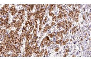 ABIN6278185 at 1/100 staining Human liver cancer tissue by IHC-P.
