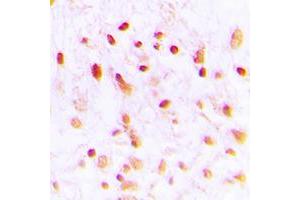 Immunohistochemical analysis of CTBP1 staining in human lung cancer formalin fixed paraffin embedded tissue section. (CTBP1 Antikörper  (C-Term))