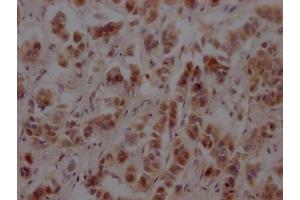 IHC image of ABIN7127649 diluted at 1:100 and staining in paraffin-embedded human breast cancer performed on a Leica BondTM system. (Rekombinanter NUP153 Antikörper)