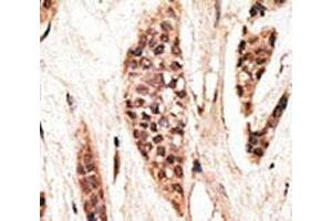 IHC analysis of FFPE human breast carcinoma tissue stained with the TAP1 antibody (TAP1 Antikörper  (AA 765-794))