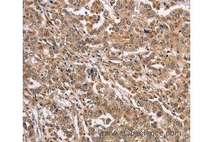 Immunohistochemistry of Human liver cancer using KCNG2 Polyclonal Antibody at dilution of 1:40 (Kcng2 Antikörper)