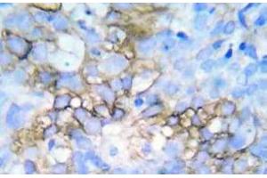 Immunohistochemistry (IHC) analyzes of p-HSP27 antibody in paraffin-embedded human breast carcinoma tissue. (HSP27 Antikörper  (pSer78, pSer82))