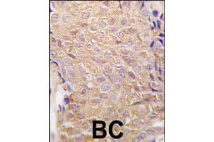 Formalin-fixed and paraffin-embedded human breast carcinoma tissue reacted with ALDH6A1 polyclonal antibody  , which was peroxidase-conjugated to the secondary antibody, followed by DAB staining. (ALDH6A1 Antikörper  (N-Term))