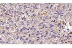 ABIN6279085 at 1/100 staining Human melanoma tissue by IHC-P. (ADAMTS13 Antikörper  (C-Term))