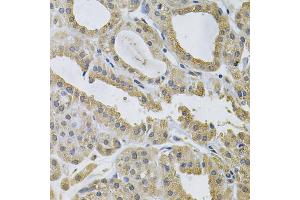 Immunohistochemistry of paraffin-embedded human thyroid cancer using NCF4 Antibody (ABIN5971122) at dilution of 1/100 (40x lens). (NCF4 Antikörper)
