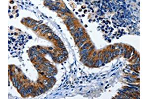 The image on the left is immunohistochemistry of paraffin-embedded Human colon cancer tissue using ABIN7191255(LAMA1 Antibody) at dilution 1/25, on the right is treated with synthetic peptide. (Laminin alpha 1 Antikörper)