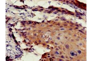 Immunohistochemistry of paraffin-embedded human cervical cancer using ABIN7172545 at dilution of 1:100 (ETV7 Antikörper  (AA 134-218))