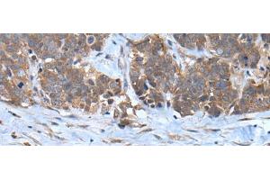 Immunohistochemistry of paraffin-embedded Human thyroid cancer tissue using CNTN1 Polyclonal Antibody at dilution of 1:35(x200) (Contactin 1 Antikörper)