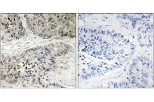 Immunohistochemistry analysis of paraffin-embedded human lung carcinoma, using MAPK15 Antibody. (MAPK15 Antikörper  (AA 361-410))