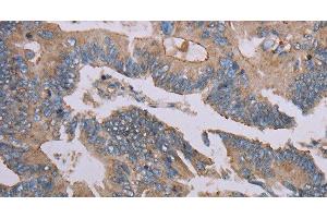Immunohistochemistry of paraffin-embedded Human colon cancer using MMP20 Polyclonal Antibody at dilution of 1:40 (MMP20 Antikörper)