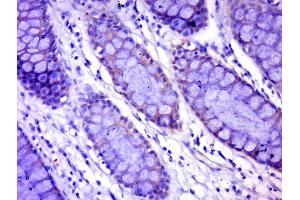 Paraformaldehyde-fixed, paraffin embedded human colon carcinoma tissue, Antigen retrieval by boiling in sodium citrate buffer(pH6) for 15min, Block endogenous peroxidase by 3% hydrogen peroxide for 30 minutes, Blocking buffer (normal goat serum) at 37°C for 20min, Antibody incubation with Rabbit Anti-C17orf82 Polyclonal Antibody, Unconjugated  at 1:400 overnight at 4°C, followed by a conjugated secondary and DAB staining (C17orf82 Antikörper)