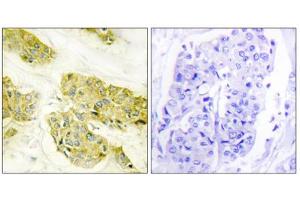 Immunohistochemistry analysis of paraffin-embedded human breast carcinoma tissue using COL5A3 antibody. (COL5A3 Antikörper  (N-Term))