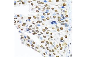 Immunohistochemistry of paraffin-embedded human prostate cancer using PTBP1 antibody at dilution of 1:100 (40x lens). (PTBP1 Antikörper)