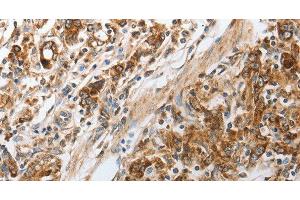 Immunohistochemistry of paraffin-embedded Human gastic cancer using NPY1R Polyclonal Antibody at dilution of 1:30 (NPY1R Antikörper)