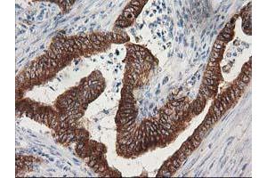 Immunohistochemical staining of paraffin-embedded Adenocarcinoma of Human colon tissue using anti-TUBB4 mouse monoclonal antibody. (TUBB4 Antikörper)