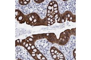 Immunohistochemical staining of human rectum with MKS1 polyclonal antibody  strong cytoplasmic positivity in glandular cells.