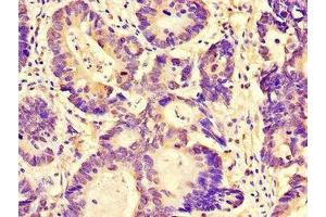 Immunohistochemistry of paraffin-embedded human colon cancer using ABIN7165414 at dilution of 1:100 (FAM151B Antikörper  (AA 1-276))