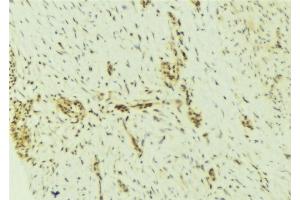 ABIN6276929 at 1/100 staining Human breast cancer tissue by IHC-P.