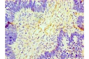 Immunohistochemistry of paraffin-embedded human ovarian cancer using ABIN7153892 at dilution of 1:100 (GCKR Antikörper  (AA 1-625))