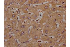 IHC image of ABIN7139992 diluted at 1:200 and staining in paraffin-embedded human liver cancer performed on a Leica BondTM system. (OR4C15 Antikörper  (AA 258-268))
