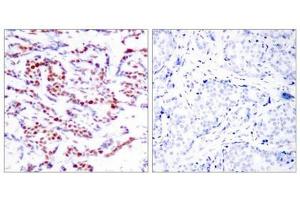 Immunohistochemical analysis of paraffin-embedded human breast carcinoma tissue using ATF2(Phospho-Ser112 or 94) Antibody(left) or the same antibody preincubated with blocking peptide(right). (ATF2 Antikörper  (pSer112))