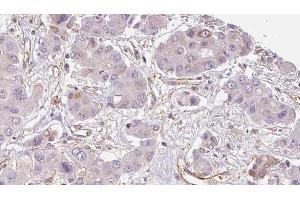 ABIN6273934 at 1/100 staining Human liver cancer tissue by IHC-P. (GPR33 Antikörper  (Internal Region))