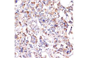 Immunohistochemistry of paraffin-embedded human breast cancer using STOML2 antibody (ABIN6132693, ABIN6148629, ABIN6148630 and ABIN6214642) at dilution of 1:100 (40x lens). (STOML2 Antikörper  (AA 29-356))