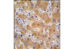 Formalin-fixed and paraffin-embedded human hepatocarcinoma tissue reacted with APOA4 antibody (N-term), which was peroxidase-conjugated to the secondary antibody, followed by DAB staining. (APOA4 Antikörper  (C-Term, N-Term))