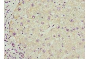 Immunohistochemistry of paraffin-embedded human liver cancer using ABIN7145588 at dilution of 1:100 (BAAT Antikörper  (AA 309-418))