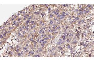 ABIN6276326 at 1/100 staining Human Melanoma tissue by IHC-P. (Midkine Antikörper  (Internal Region))
