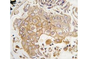 IHC analysis of FFPE human lung carcinoma tissue stained with CYP1A1 antibody (CYP1A1 Antikörper  (AA 377-405))
