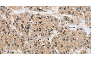 Immunohistochemistry of paraffin-embedded Human liver cancer tissue using AMZ2 Polyclonal Antibody at dilution 1:40 (AMZ2 Antikörper)