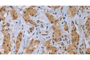 Immunohistochemistry of paraffin-embedded Human breast cancer tissue using CLEC1A Polyclonal Antibody at dilution 1:40 (CLEC1A Antikörper)