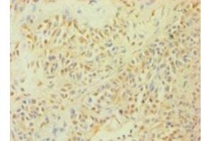 Immunohistochemistry of paraffin-embedded human breast cancer using ABIN7146925 at dilution of 1:100 (Caspase 1 Antikörper  (AA 120-269))