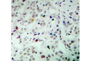 Immunohistochemistry (IHC) image for anti-Retinoblastoma 1 (RB1) (pSer780) antibody (ABIN1681996) (Retinoblastoma 1 Antikörper  (pSer780))