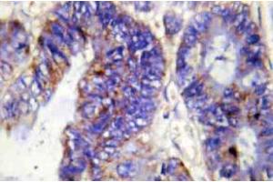 Immunohistochemistry (IHC) analyzes of COL4A2 antibody in paraffin-embedded human colon carcinoma tissue. (COL4a2 Antikörper  (Chain alpha 2))