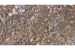 Immunohistochemistry of paraffin-embedded Human cervical cancer using Cytochrome b5 Polyclonal Antibody at dilution of 1:40 (Cytochrome b5 (CYTB5) Antikörper)