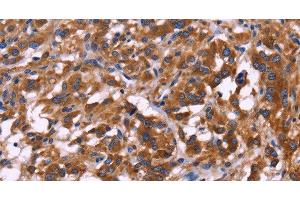 Immunohistochemistry of paraffin-embedded Human thyroid cancer tissue using KIR2DL1/3/4/S4 Polyclonal Antibody at dilution 1:30 (KIR2DL1/3/4/S4 Antikörper)