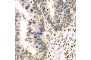 Immunohistochemistry of paraffin-embedded human colon carcinoma using HDAC2 antibody. (HDAC2 Antikörper  (C-Term))