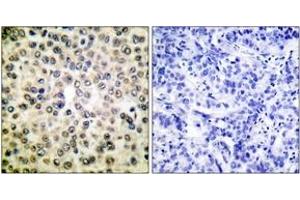 Immunohistochemistry analysis of paraffin-embedded human breast carcinoma tissue, using NF-kappaB p65 (Ab-310) Antibody. (NF-kB p65 Antikörper  (AA 275-324))