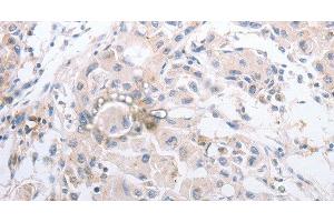 Immunohistochemistry of paraffin-embedded Human lung cancer using MMP11 Polyclonal Antibody at dilution of 1:40 (MMP11 Antikörper)